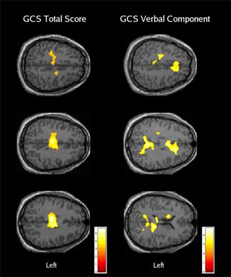 Functional Magnetic Resonance Imaging of Cognitive Control following Traumatic Brain Injury